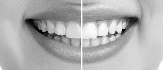 Blanqueamiento Dental