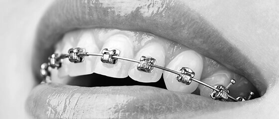 Brackets