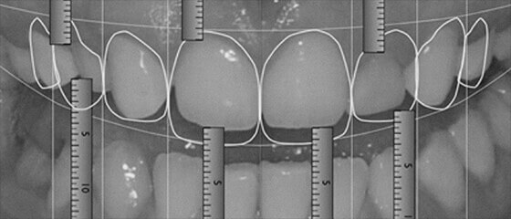 Diseño de sonrisa digital