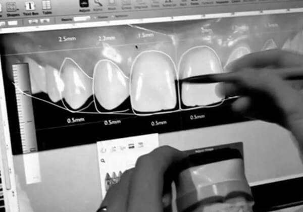 Diseño Digital de la Sonrisa